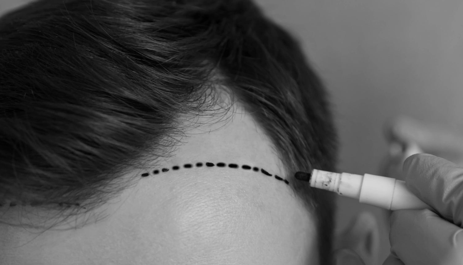 Man preparing for hair transplant surgery